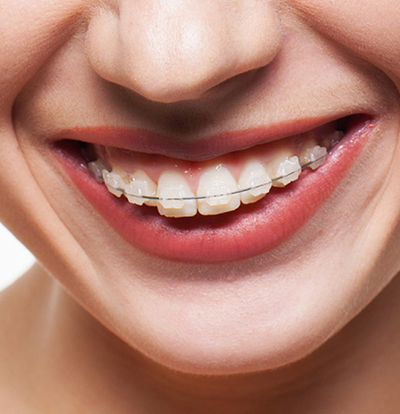 are there alternatives to braces