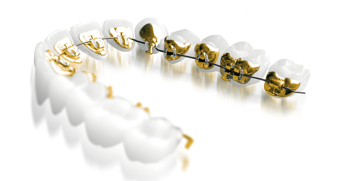 Why is Nitinol used in braces? Splash Orthodontics