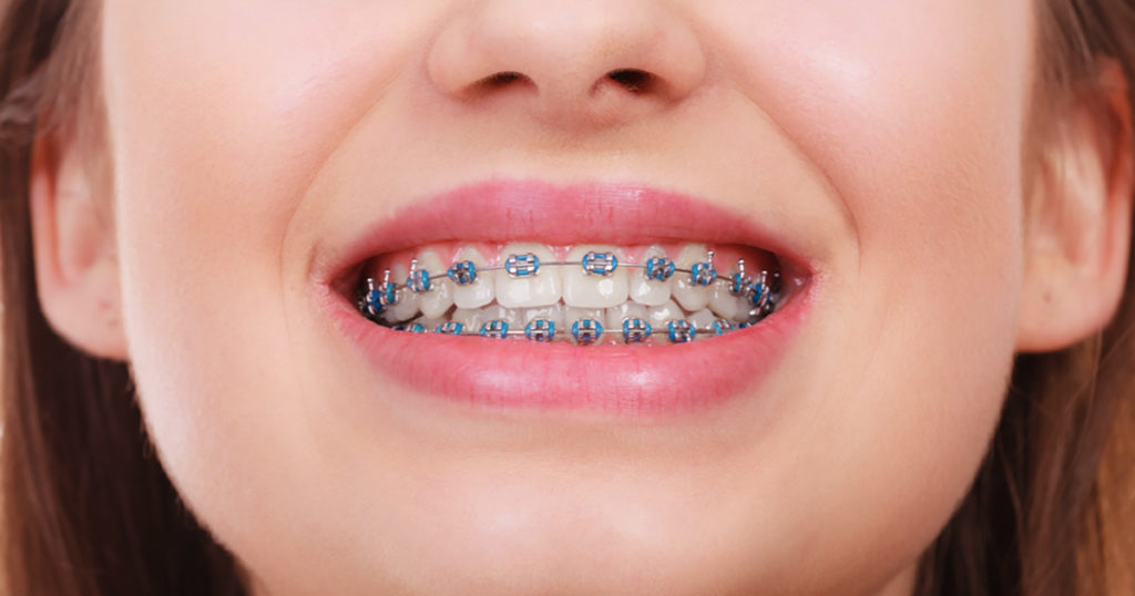 Teeth Braces in Brighton & Hove Clear Braces Splash Orthodontics
