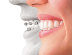 gum recession