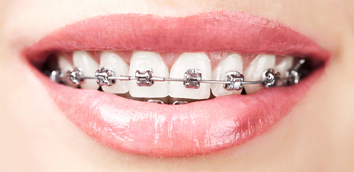 Invisalign vs braces