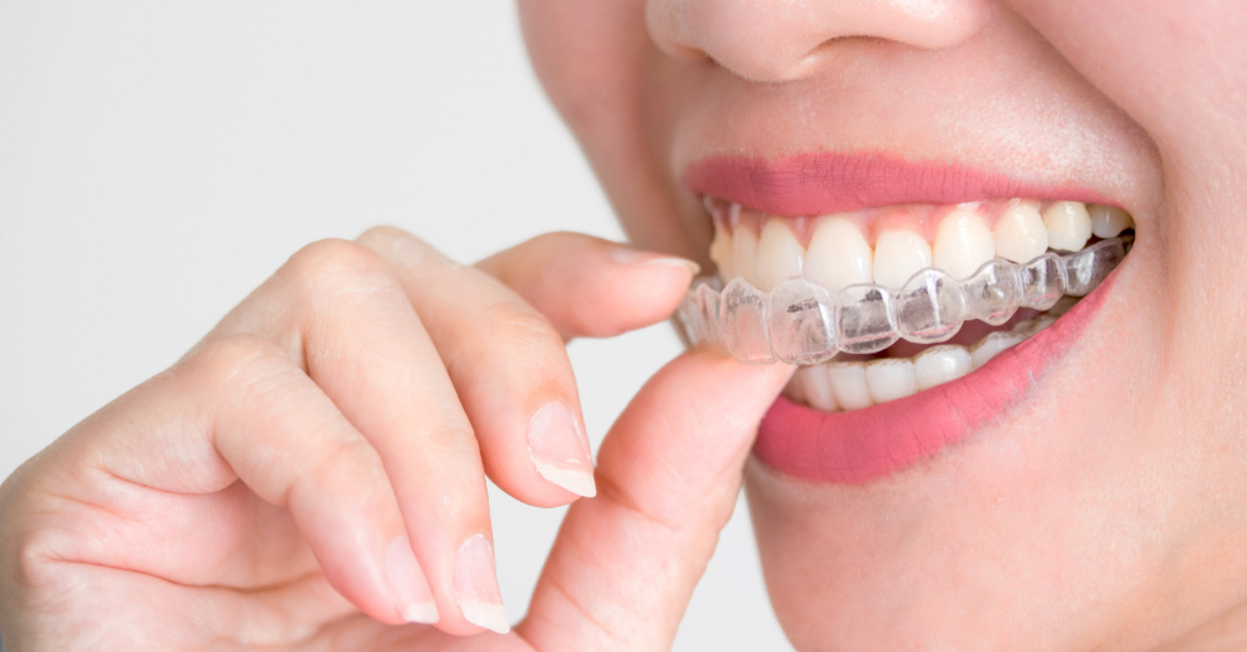 Can You Wear Braces On Your Top Teeth Only Splash Orthodontics 