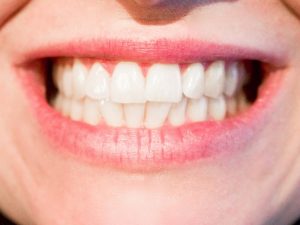 teeth straightening