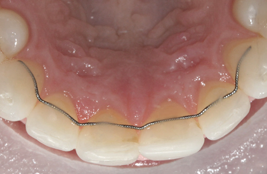 Fixed retainer