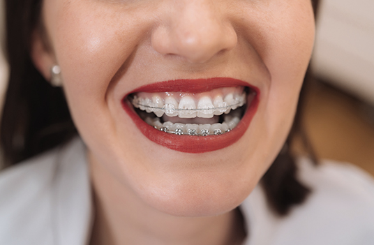 How braces work