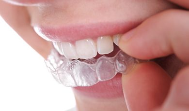 Invisalign Teen aligner