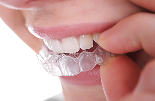 Invisalign Teen aligner