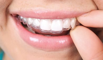 Removable retainer