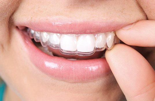 Removable retainer