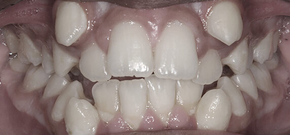 Braces Before And After Invisalign Results Splash Orthodontics 