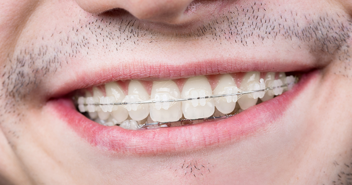 Interproximal reduction