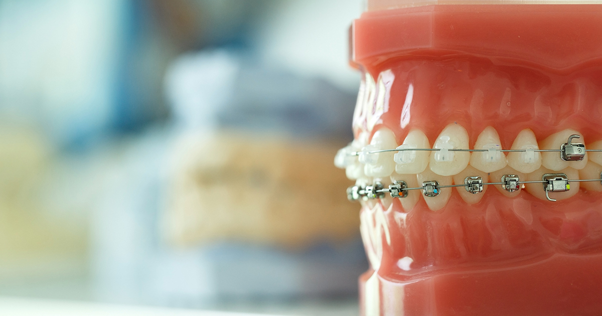 How quickly can we move teeth