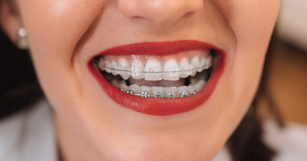 Clear braces Brighton and Hove